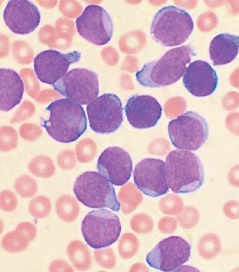 Image: Bone marrow aspirate smear of patient with precursor B-cell acute lymphoblastic leukemia (Photo courtesy of VashiDonsk).